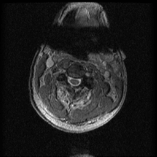File:Cervical canal stenosis with cord compression (Radiopaedia 34114-35374 Axial Gradient Echo 71).png