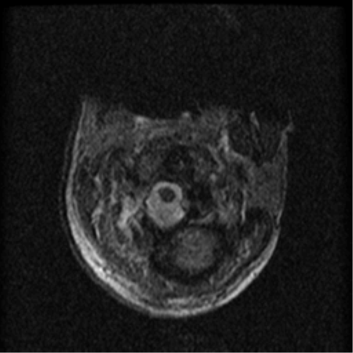 Cervical canal stenosis with cord compression (Radiopaedia 34114-35374 Axial Gradient Echo 92).png