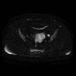 File:Cervical carcinoma (Radiopaedia 67644-77047 Axial DWI 10).jpg