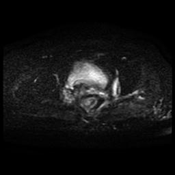File:Cervical carcinoma (Radiopaedia 70924-81132 Axial DWI 29).jpg