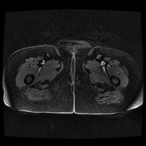 File:Cervical carcinoma (Radiopaedia 70924-81132 Axial T1 C+ fat sat 11).jpg