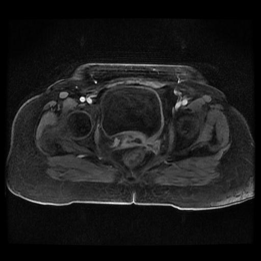 Cervical carcinoma (Radiopaedia 70924-81132 Axial T1 C+ fat sat 219).jpg