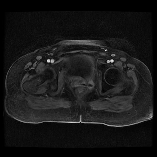 File:Cervical carcinoma (Radiopaedia 70924-81132 Axial T1 C+ fat sat 36).jpg