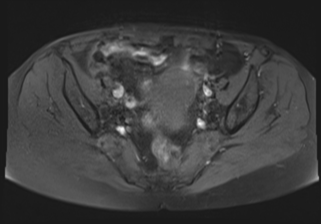 File:Cervical carcinoma (Radiopaedia 88312-104943 Axial T1 fat sat 10).jpg