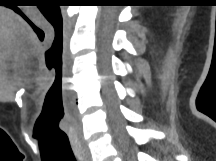File:Cervical disc replacement (Radiopaedia 44025-47541 B 49).png