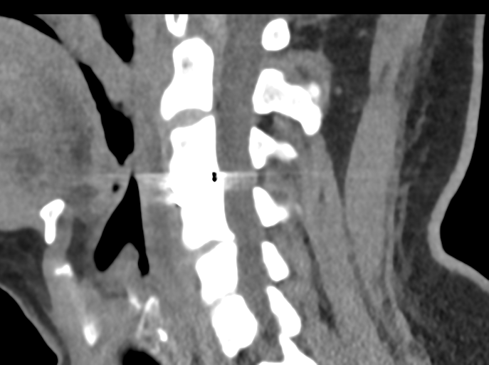 File:Cervical disc replacement (Radiopaedia 44025-47541 B 55).png