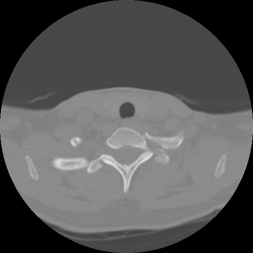 Cervical rib (Radiopaedia 71110-81363 Axial non-contrast 45).jpg