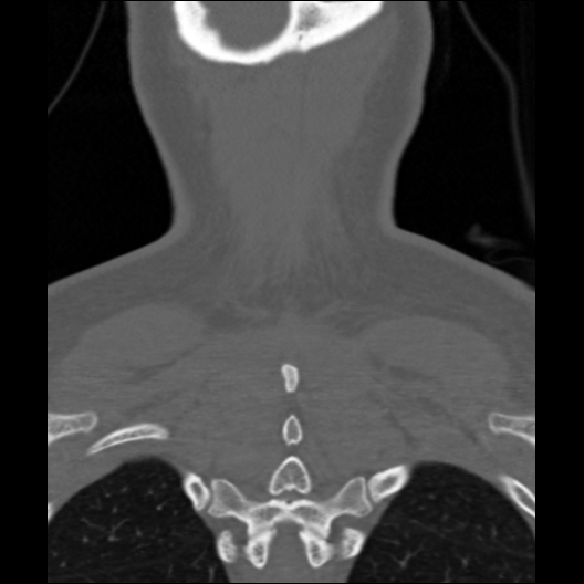 File:Cervical rib (Radiopaedia 71110-81363 Coronal non-contrast 10).jpg
