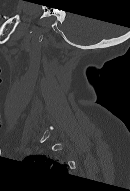 Cervical spine ACDF loosening (Radiopaedia 48998-54070 Sagittal bone window 21).png