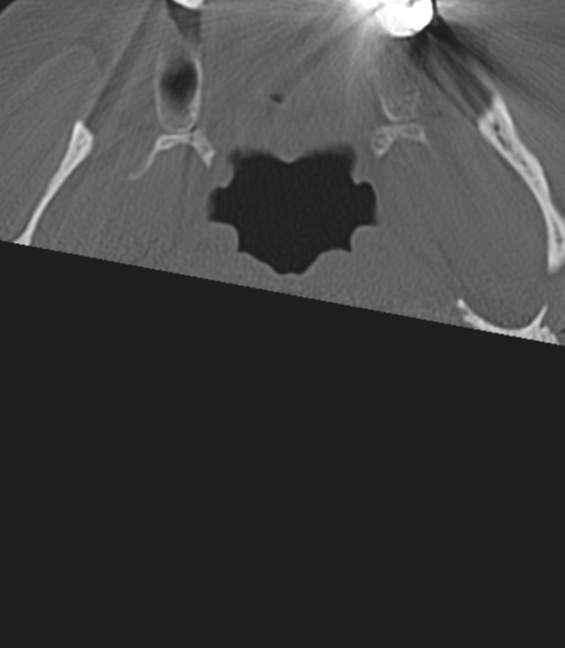 File:Cervical spine fractures with vertebral artery dissection (Radiopaedia 53296-59268 Axial bone window 3).png