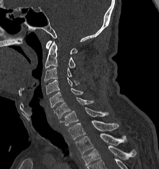Cervical spine trauma with tear drop fracture and perched facet joint (Radiopaedia 53989-60127 Sagittal bone window 79).jpg