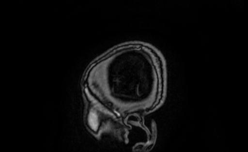 Cervical spondylodiscitis and calvarial hemangioma (Radiopaedia 64317-73103 Sagittal T1 C+ 2).jpg