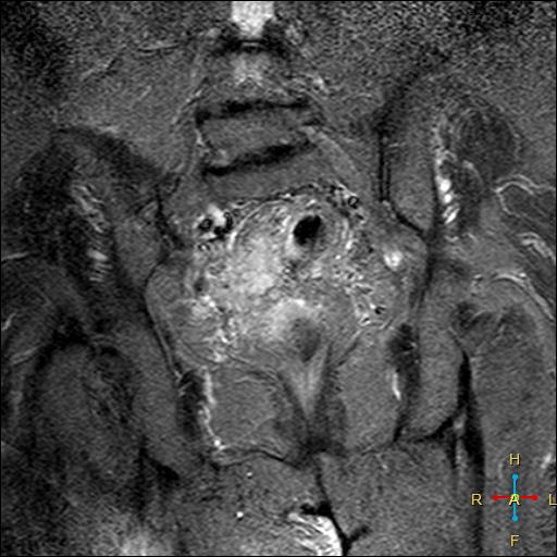 File:Cervical stump squamous cell carcinoma (Radiopaedia 48049-52858 G 9).jpg