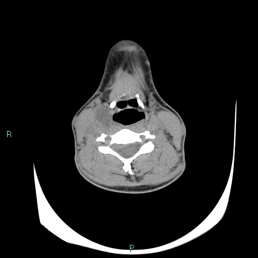 Cervical thymic cyst (Radiopaedia 88632-105335 Axial non-contrast 61).jpg