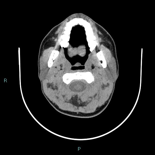 File:Cervical thymic cyst (Radiopaedia 88632-105335 Axial non-contrast 89).jpg