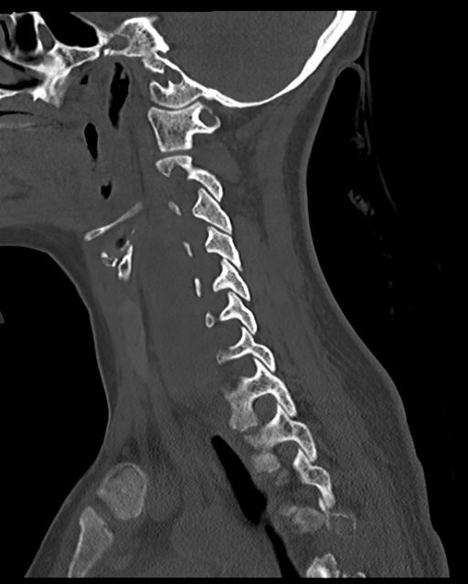 Cervical tuberculous spondylitis (Radiopaedia 39149-41365 Sagittal bone window 25).png