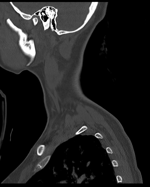 Cervical tuberculous spondylitis (Radiopaedia 39149-41365 Sagittal bone window 63).png