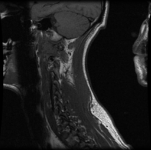 File:Cervical vertebrae metastasis (Radiopaedia 78814-91667 Sagittal T1 11).png