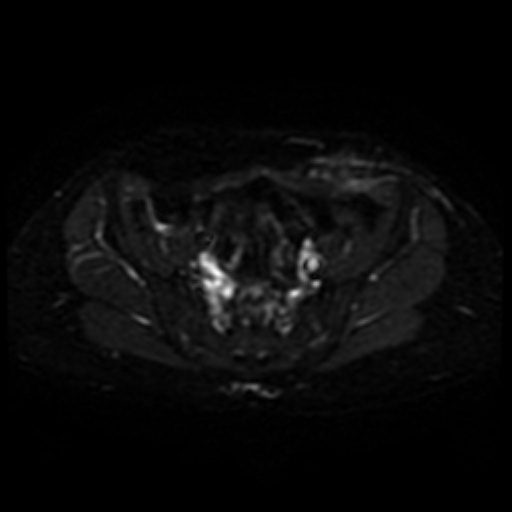 Cesarian section scar endometriosis (Radiopaedia 66520-75799 Axial DWI 7).jpg