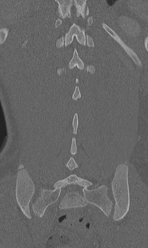 Chance fracture (Radiopaedia 40360-42912 Coronal bone window 55).png