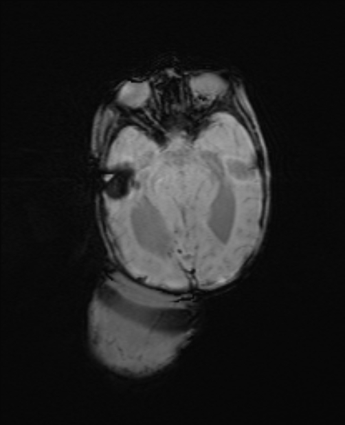 Chiari III malformation with occipital encephalocele (Radiopaedia 79446-92559 Axial SWI 32).jpg