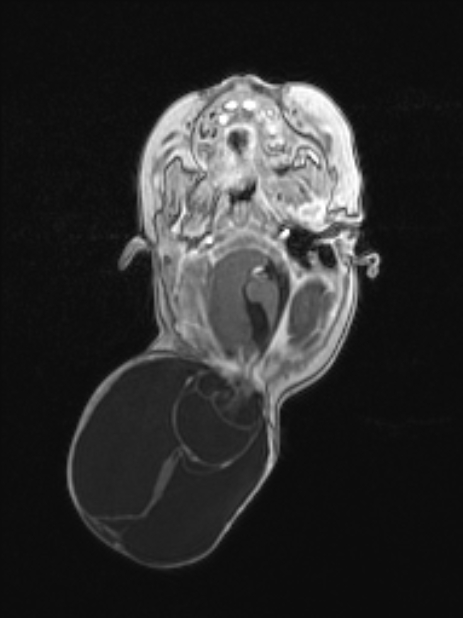 Chiari III malformation with occipital encephalocele (Radiopaedia 79446-92559 Axial T1 C+ mpr 33).jpg