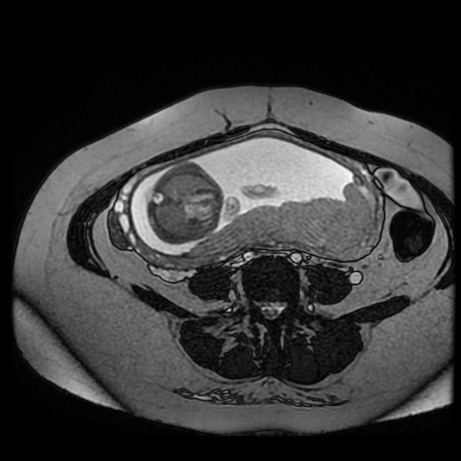 Chiari II malformation - fetal MRI (Radiopaedia 68099-77581 Axial Fiesta 20).jpg