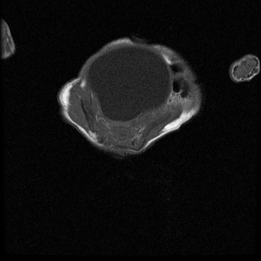 File:Chiari II malformation with spinal meningomyelocele (Radiopaedia 23550-23652 Axial T1 16).jpg