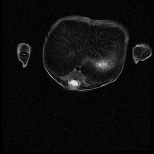 File:Chiari II malformation with spinal meningomyelocele (Radiopaedia 23550-23652 Axial T2 7).jpg