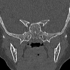 Choanal atresia (Radiopaedia 88525-105975 Coronal bone window 90).jpg