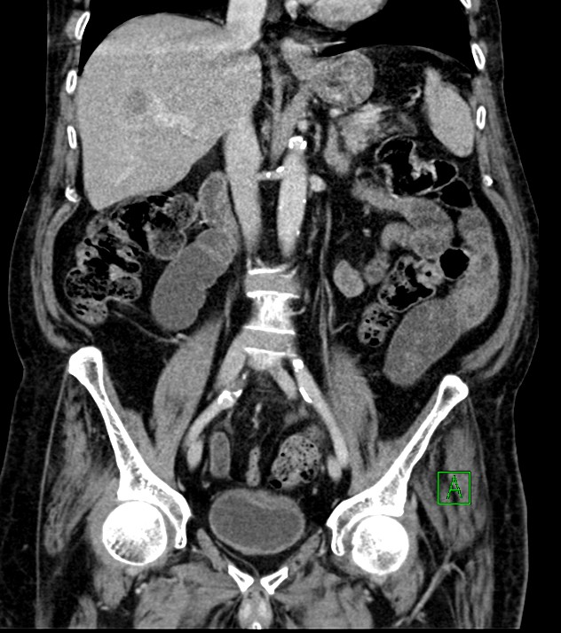 Cholangiocarcinoma with cerebral metastases (Radiopaedia 83519-98629 G 43).jpg
