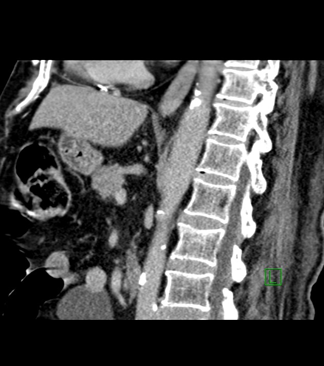 Cholangiocarcinoma with cerebral metastases (Radiopaedia 83519-98629 Sagittal C+ delayed 54).jpg