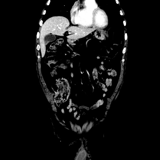 Choledocholiathiasis with normal caliber common bile duct (Radiopaedia 75368-86632 Coronal liver window 41).jpg