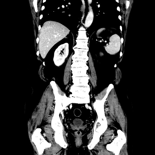 Choledocholiathiasis with normal caliber common bile duct (Radiopaedia 75368-86632 Coronal liver window 86).jpg