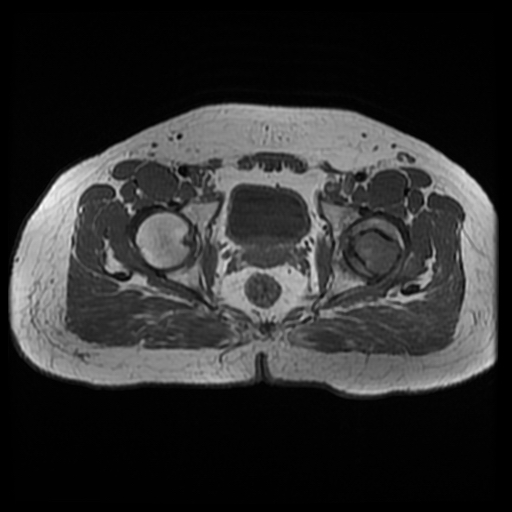 File:Chondroblastoma (Radiopaedia 12264-12564 Axial T1 6).jpg