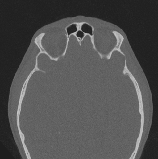 Chondrosarcoma (clivus) (Radiopaedia 46895-51425 Axial bone window 13).png