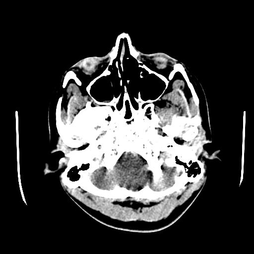 File:Choriocarcinoma of ovary with cerebral and pulmonary metastases (Radiopaedia 25983-26118 C+ arterial phase 10).jpg