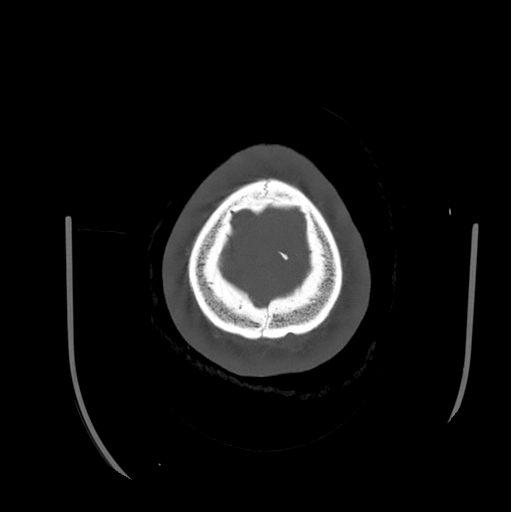 Choroid plexus papilloma extending into the cerebellopontine angle cistern (Radiopaedia 85941-101833 Axial bone window 87).png