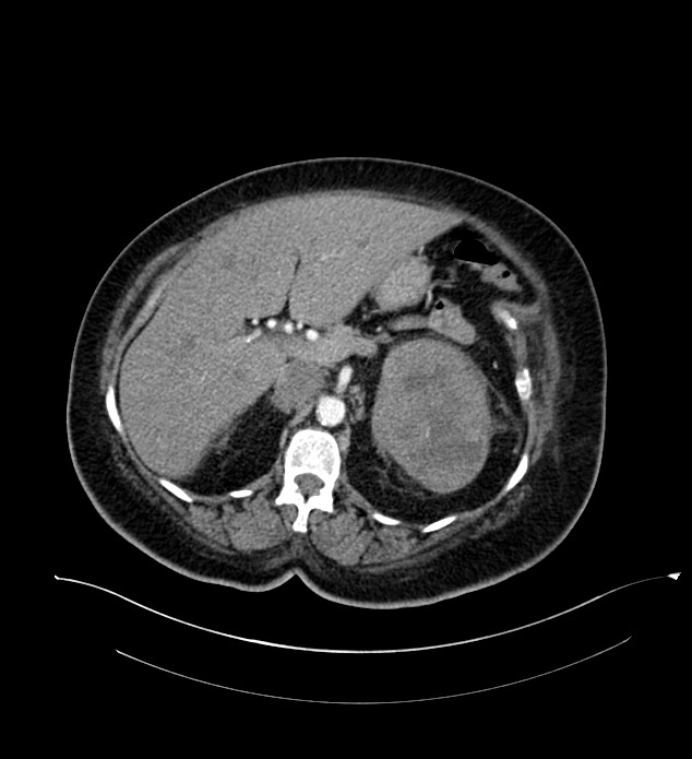 Chromophobe renal cell carcinoma (Radiopaedia 84239-99519 B 36).jpg