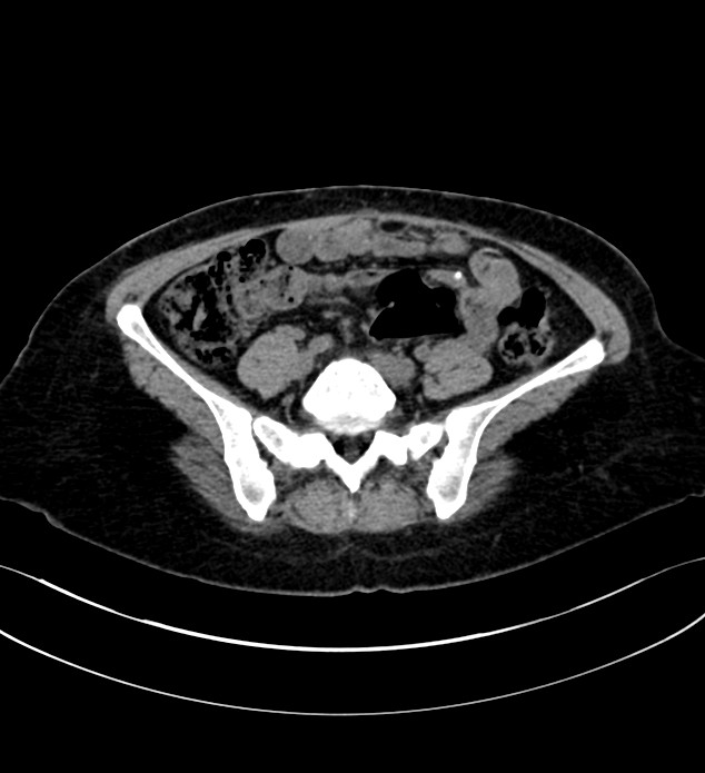 Chromophobe renal cell carcinoma (Radiopaedia 84290-99582 Axial non-contrast 103).jpg