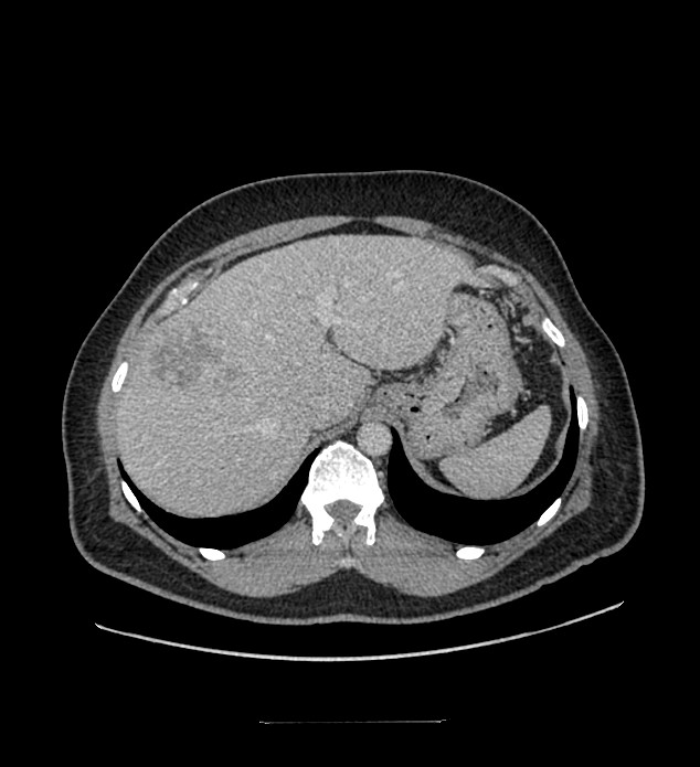 Chromophobe renal cell carcinoma (Radiopaedia 84337-99644 C 28).jpg
