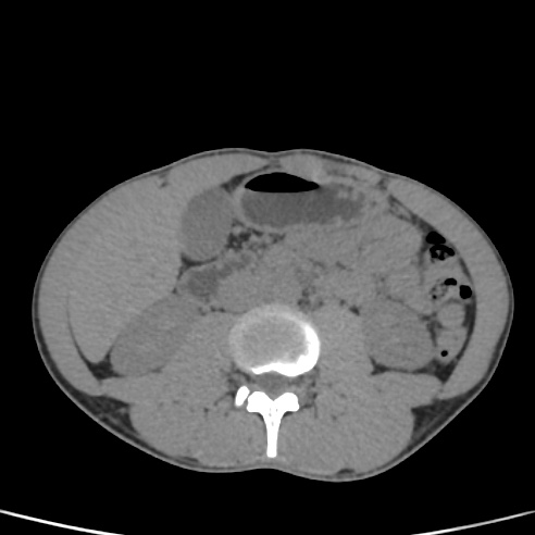 File:Chronic calcific pancreatitis (Radiopaedia 56280-62953 Axial non-contrast 30).jpg