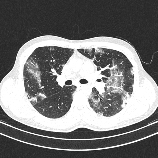Chronic eosinophilic pneumonia (Radiopaedia 39331-41587 Axial lung window 21).png