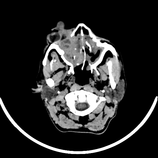 File:Chronic invasive fungal sinusitis with intraorbital and intracranial extension (Radiopaedia 56387-63046 Axial non-contrast 71).jpg