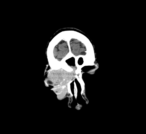 Chronic invasive fungal sinusitis with intraorbital and intracranial extension (Radiopaedia 56387-63046 C 48).jpg