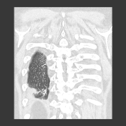File:Chronic lung allograft dysfunction - restrictive form (Radiopaedia 60595-68316 Coronal lung window 83).jpg
