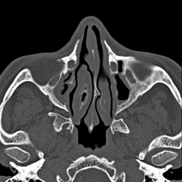 Chronic maxillary sinusitis (Radiopaedia 27879-28116 Axial bone window 21).jpg