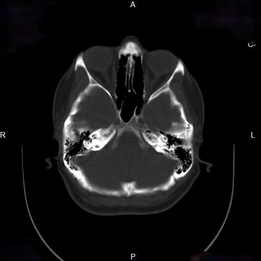 File:Chronic maxillary sinusitis with a foreign body (dental filling material) (Radiopaedia 7811-8639 Axial bone window 11).jpg