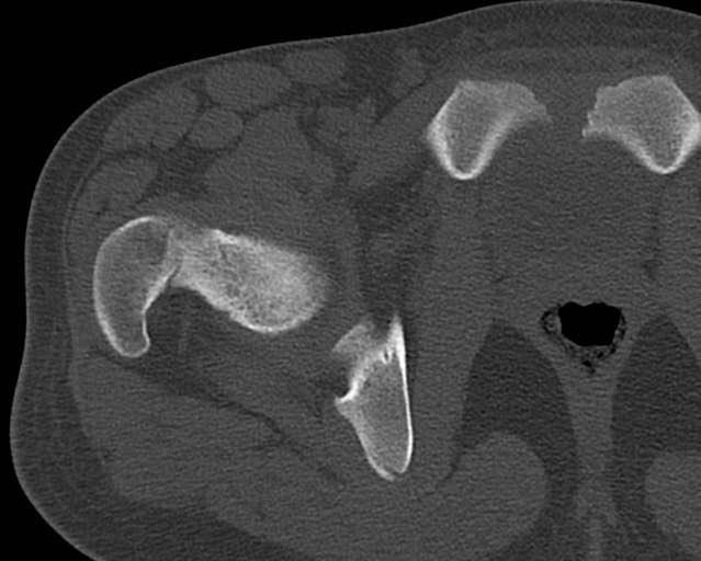 Chronic ostemyelitis of the femur with long sinus tract (Radiopaedia 74947-85982 Axial bone window 5).jpg