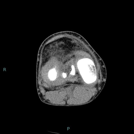 Chronic osteomyelitis (with Brodie abscess) (Radiopaedia 76405-88111 A 113).jpg
